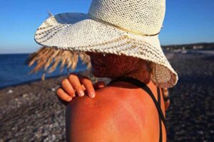 обгорела кожа